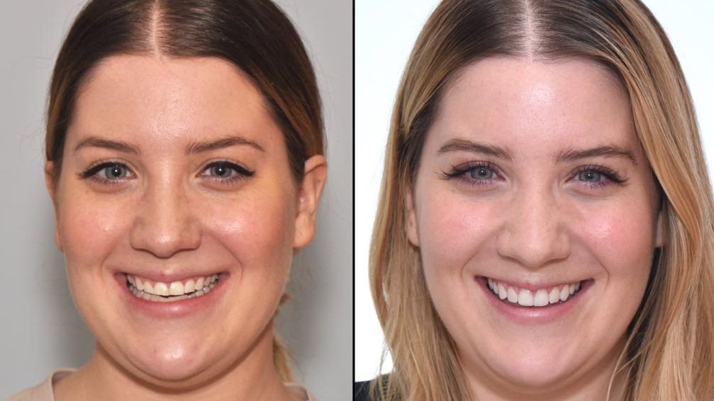 Antes e depois de facetas de porcelana