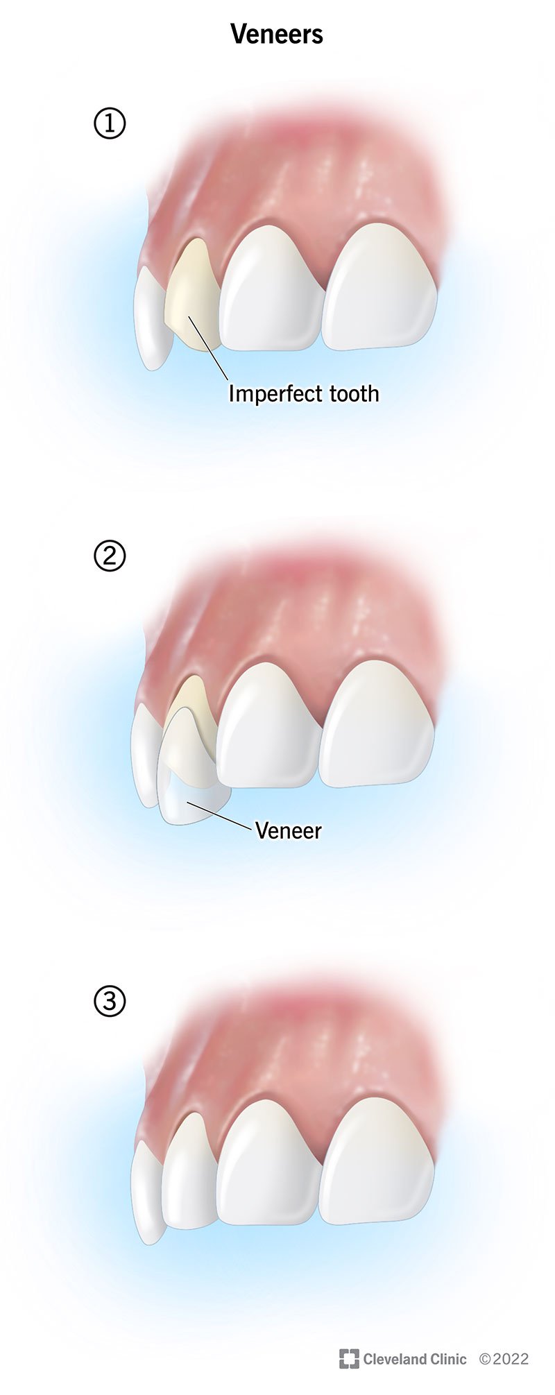 Ilustração de como a faceta é aplicada no dente